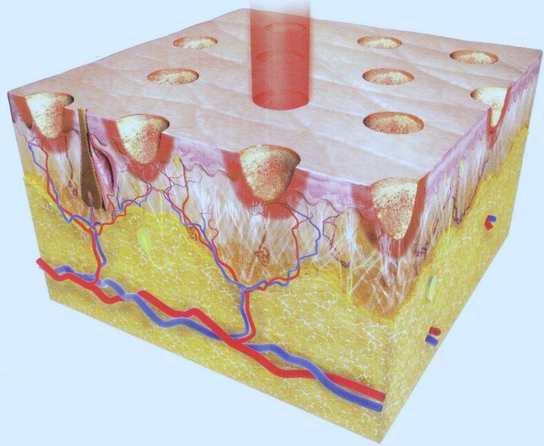 Fraktiouns Laser Thermolyse