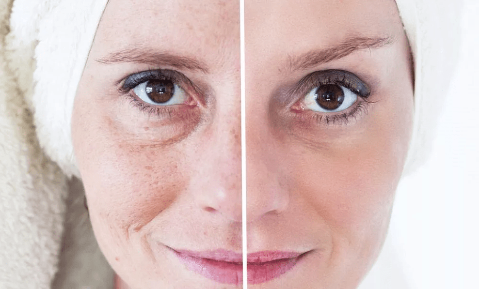 Laser Gesiicht Verjüngung